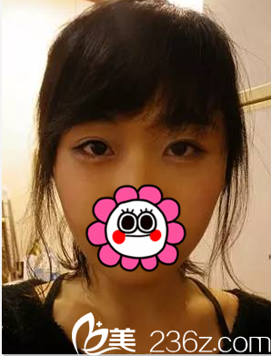 在北京美萊做玻尿酸豐臥蠶注射瘦臉第2天樣子 在北京美萊做玻尿酸豐臥蠶注射瘦臉第2天樣子