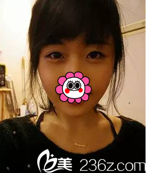 找周福田做玻尿酸豐臥蠶注射瘦臉第5天 找周福田做玻尿酸豐臥蠶注射瘦臉第5天