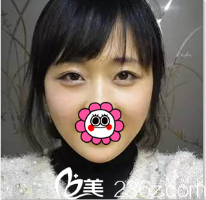 北京美萊玻尿酸豐臥蠶注射瘦臉案例 北京美萊玻尿酸豐臥蠶注射瘦臉案例