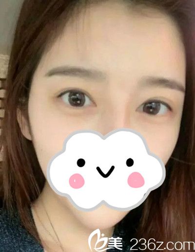 雙眼皮手術(shù)前 雙眼皮手術(shù)前