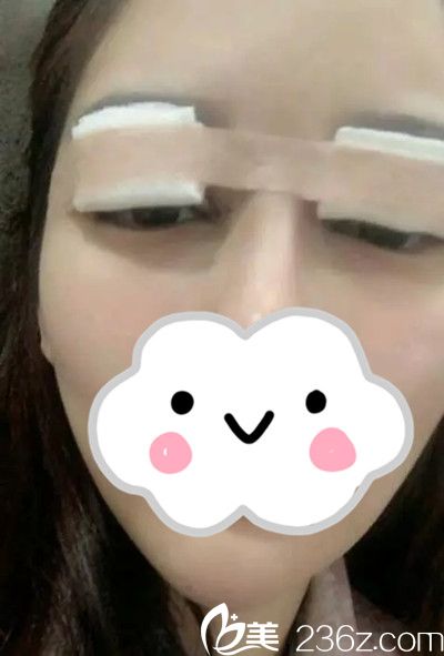 雙眼皮手術(shù)修復(fù)后第1天 雙眼皮手術(shù)修復(fù)后第1天