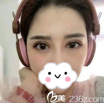 雙眼皮修復(fù)14天后恢復(fù)情況 雙眼皮修復(fù)14天后恢復(fù)情況