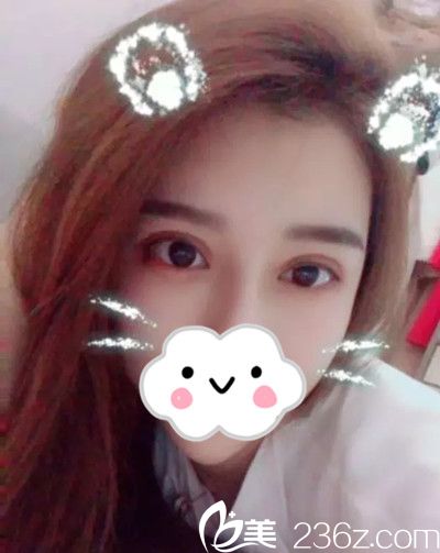 韓國美作整形醫(yī)院雙眼皮修復(fù)手術(shù)案例 韓國美作整形醫(yī)院雙眼皮修復(fù)手術(shù)案例