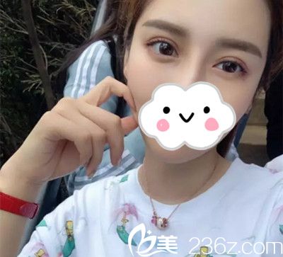 雙眼皮修復(fù)一個(gè)月后 雙眼皮修復(fù)一個(gè)月后