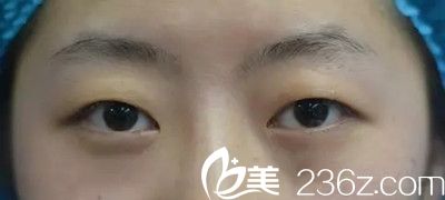 雙眼皮手術(shù)前照片 雙眼皮手術(shù)前照片