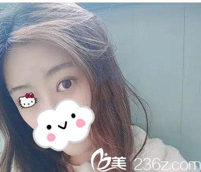 雙眼皮手術(shù)45天后恢復(fù)情況 雙眼皮手術(shù)45天后恢復(fù)情況