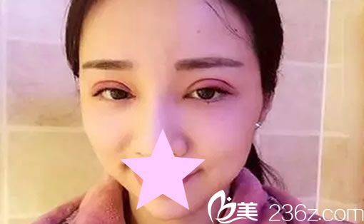 全切雙眼皮術后第二天 全切雙眼皮術后第二天
