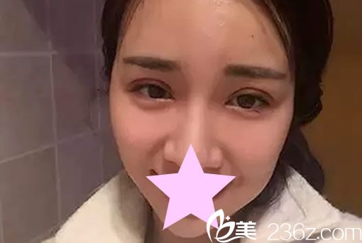 全切雙眼皮7天恢復圖片 全切雙眼皮7天恢復圖片