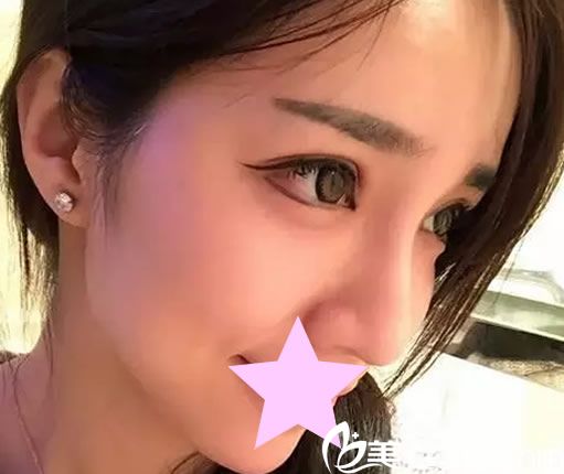 雙眼皮10天恢復圖 雙眼皮10天恢復圖