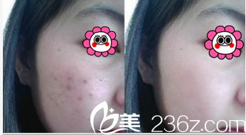 北京潤美玉之光陳立博祛痘案例