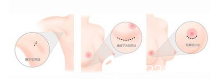 假體隆胸手術(shù)切口