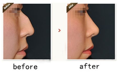 韓國多友整形醫(yī)院駝峰鼻矯正案例對比圖 韓國多友整形醫(yī)院駝峰鼻矯正案例對比圖