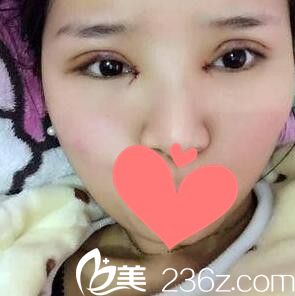 在韓國BCI做眼綜合術(shù)后第3天照