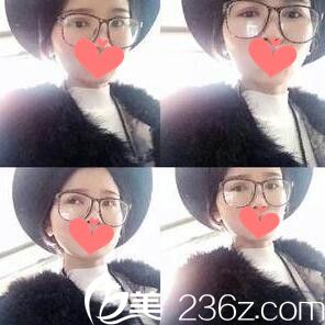 雙眼皮+開眼角術(shù)后一周拆線