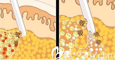 韓國張益秀整形外科張益秀抽脂塑形