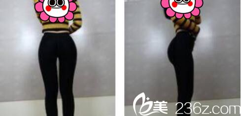 韓國張益秀整形外科張益秀抽脂瘦小腿真人案例術(shù)后十五天
