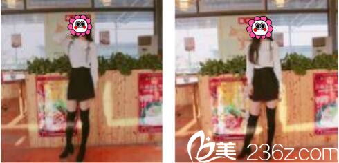 韓國張益秀整形外科張益秀抽脂瘦小腿真人案例術(shù)后一個(gè)月