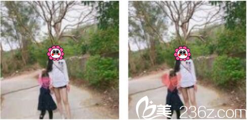 韓國張益秀整形外科張益秀抽脂瘦小腿真人案例術(shù)后兩個(gè)月