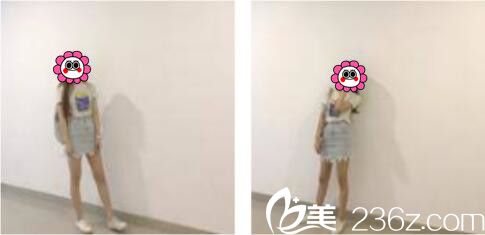 直播我在韓國張益秀整形外科做的抽脂瘦小腿術(shù)手術(shù)過程，張益秀抽脂技術(shù)真的不是吹的