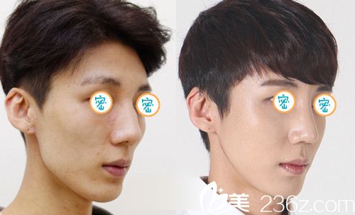 趙修永院長鼻部整形案例 趙修永院長鼻部整形案例