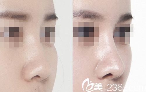 趙修永院長隆鼻手術(shù)案例 趙修永院長隆鼻手術(shù)案例