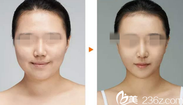 金鎮(zhèn)亨院長(zhǎng)鼻部整形真人案例 金鎮(zhèn)亨院長(zhǎng)鼻部整形真人案例