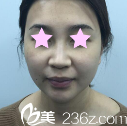 我在太原歐美蓮整形美容醫(yī)院做面部線雕提升前的照片 我在太原歐美蓮整形美容醫(yī)院做面部線雕提升前的照片