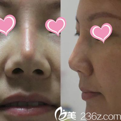 隆鼻失敗照片 隆鼻失敗照片