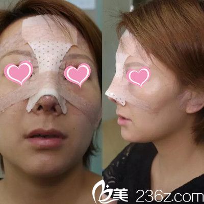 術(shù)后1天 術(shù)后1天