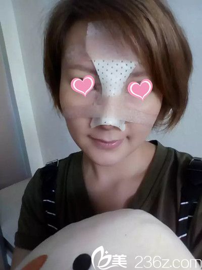 鼻綜合手術(shù)后3天 鼻綜合手術(shù)后3天