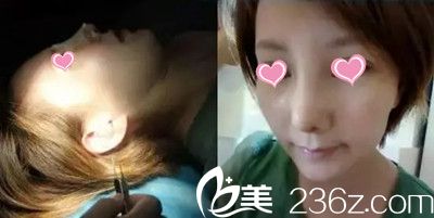 韓國趙修永鼻修復(fù)手術(shù)案例 韓國趙修永鼻修復(fù)手術(shù)案例