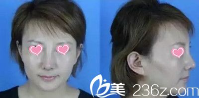 趙修永院長鼻綜合手術(shù)案例 趙修永院長鼻綜合手術(shù)案例