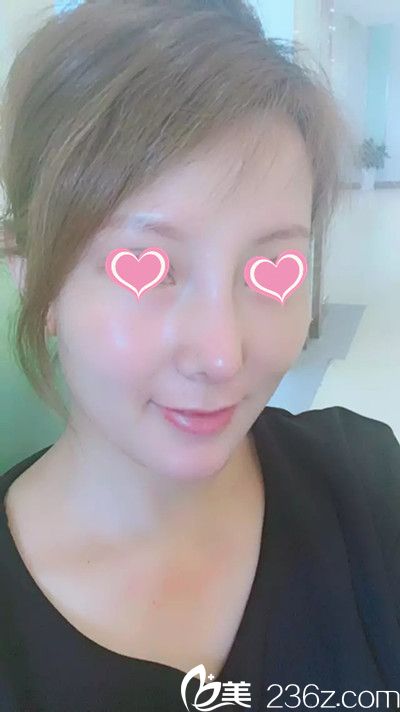 隆鼻失敗后我的人生近臨崩潰，幸虧遇見韓國趙修永醫(yī)生，用鼻修復(fù)手術(shù)拯救了我