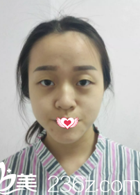 術(shù)前是無(wú)神單眼皮 術(shù)前是無(wú)神單眼皮