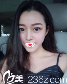 在唐山頤安娜做完切開雙眼皮術后由無神單眼皮蛻變成睫毛自然上翹的靈動大雙眼