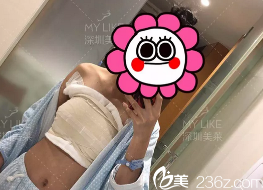 假體隆胸術后四天 假體隆胸術后四天