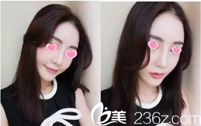 金榮洙院長隆鼻手術(shù)案例