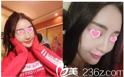 韓國雅佳整形醫(yī)院隆鼻手術(shù)案例