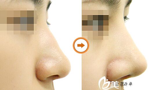 駝峰鼻矯正對(duì)比案例