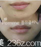 韓國Pomme breast整形外科下巴整形案例