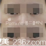 韓國Pomme breast整形外科臥蠶再造案例
