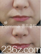 韓國Pomme breast整形外科去除法令紋案例