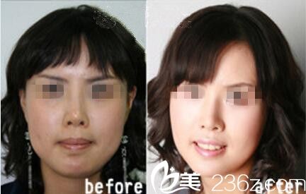 金鐘瑞下頜角真人前后對比展示 金鐘瑞下頜角真人前后對比展示