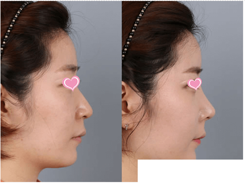 金德中院長駝峰鼻矯正手術(shù)案例對(duì)比 金德中院長駝峰鼻矯正手術(shù)案例對(duì)比