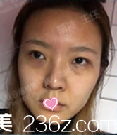 在北京聯(lián)合麗格做面部提升前樣子 在北京聯(lián)合麗格做面部提升前樣子