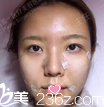 北京聯(lián)合麗格悅生線面部提升當(dāng)天樣子 北京聯(lián)合麗格悅生線面部提升當(dāng)天樣子