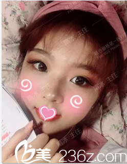 北京聯(lián)合麗格隋冰悅生線面部提升案例第15天效果 北京聯(lián)合麗格隋冰悅生線面部提升案例第15天效果