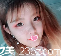 北京聯(lián)合麗格悅生線面部提升案例 北京聯(lián)合麗格悅生線面部提升案例