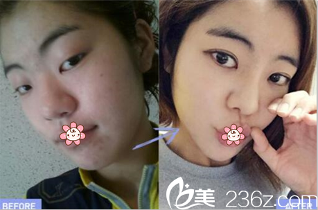 金陽洙院長雙眼皮案例