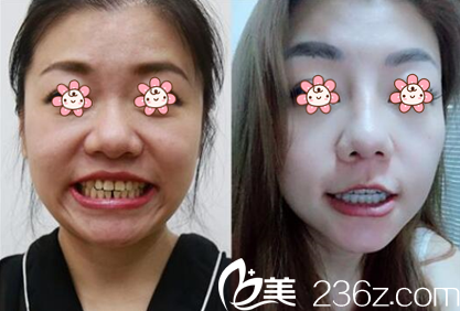 金元鎮(zhèn)院長牙齒矯正案例